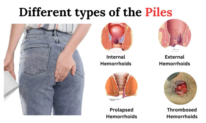 piles