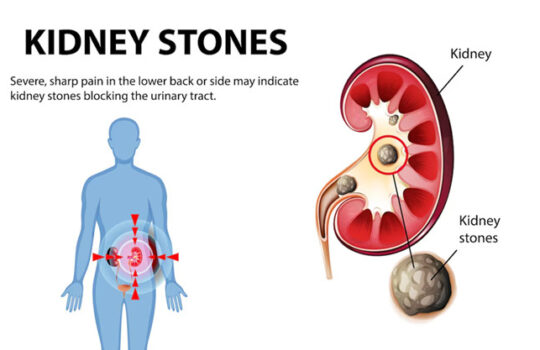Kidney Stone