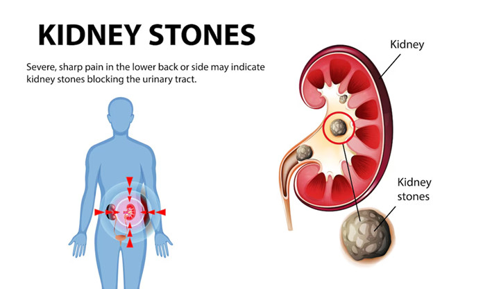 Kidney Stone