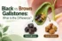 black-vs-brown-gallstones-870×563