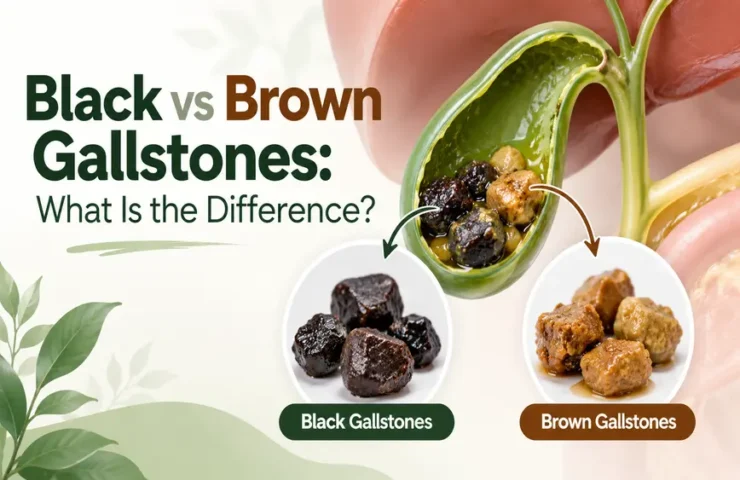 black-vs-brown-gallstones-870×563